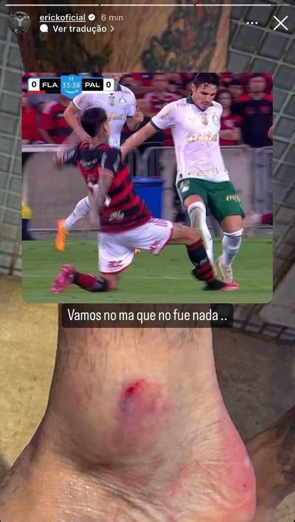 Pulgar, do Flamengo, compartilha imagem do tornozelo machucado após entrada de Raphael Veiga, do Palmeiras; confira foto